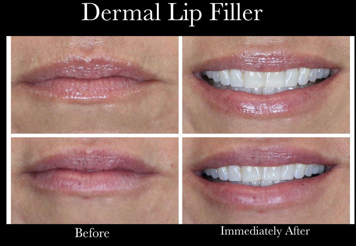 before and after photo with dermal fillers in Covington