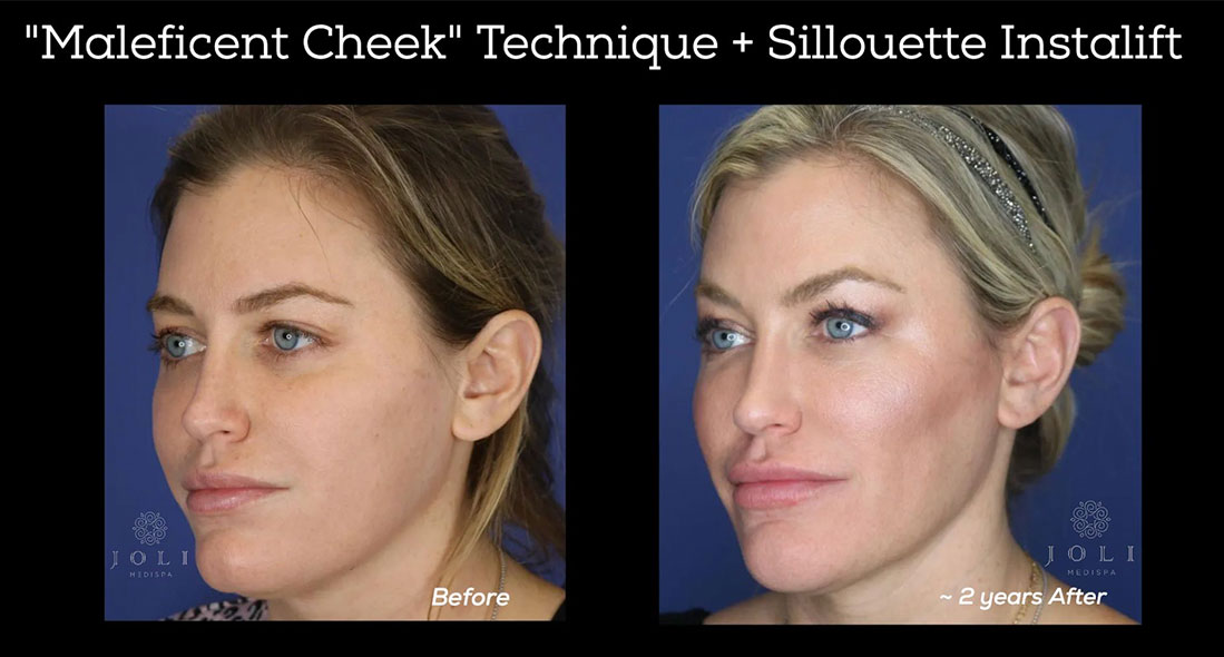 before and after silhouette instalift